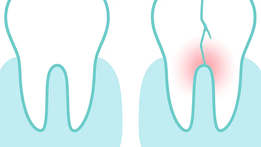 健康な歯根と破折して周囲に炎症が及んだ歯根を並べた比較図