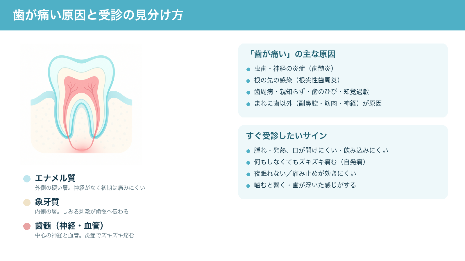 歯が痛いときの全体像。歯の三層構造(エナメル質・象牙質・歯髄)と根の先の炎症を示しつつ、主な原因とすぐ受診したいサインをまとめた解説図