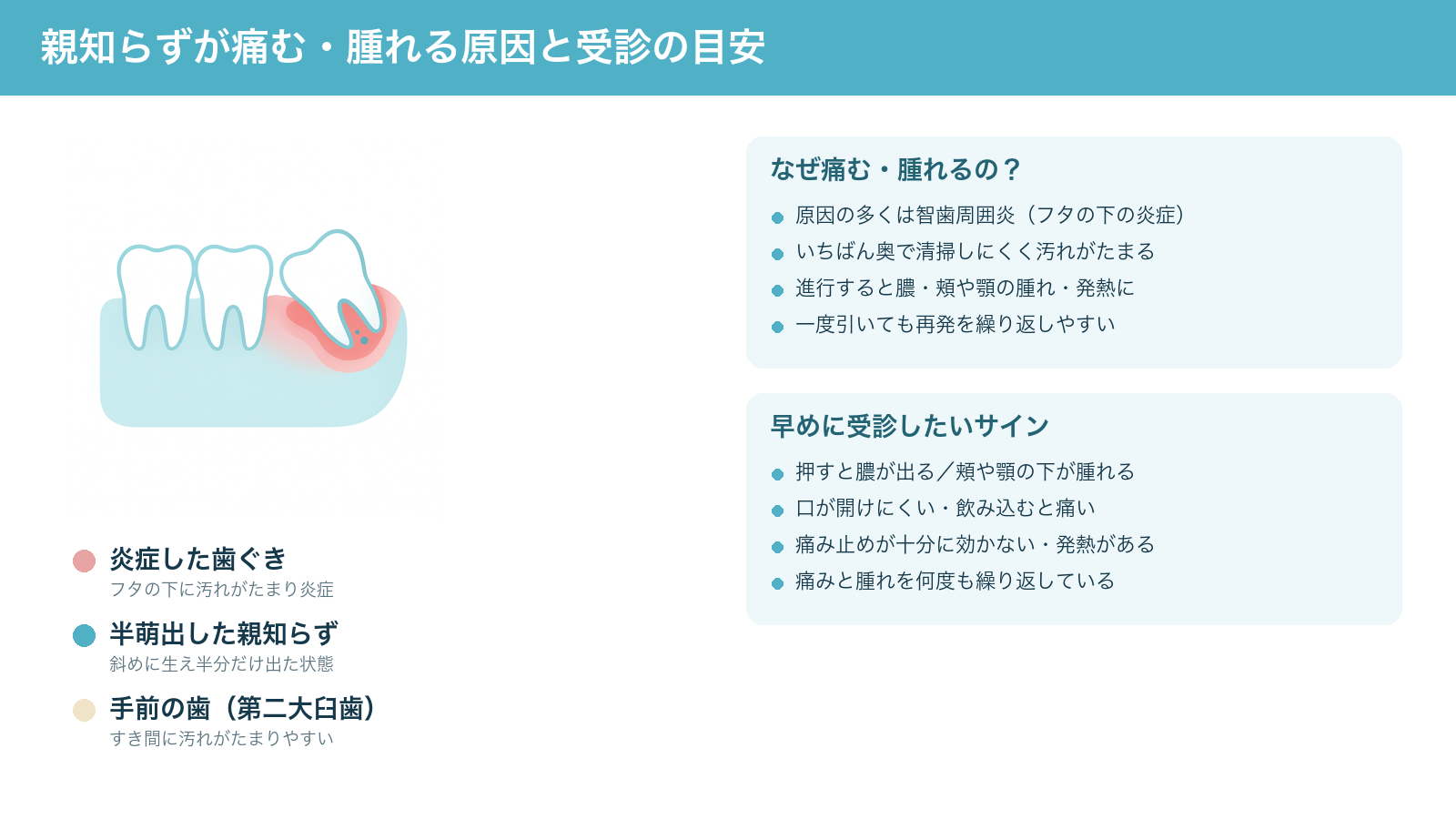 親知らずが痛む・腫れる仕組みの解説図。半分だけ生えた親知らずがフタ状の歯ぐきに覆われ、その下に汚れがたまって智歯周囲炎が起きる様子と、早めに受診したいサインをまとめた図