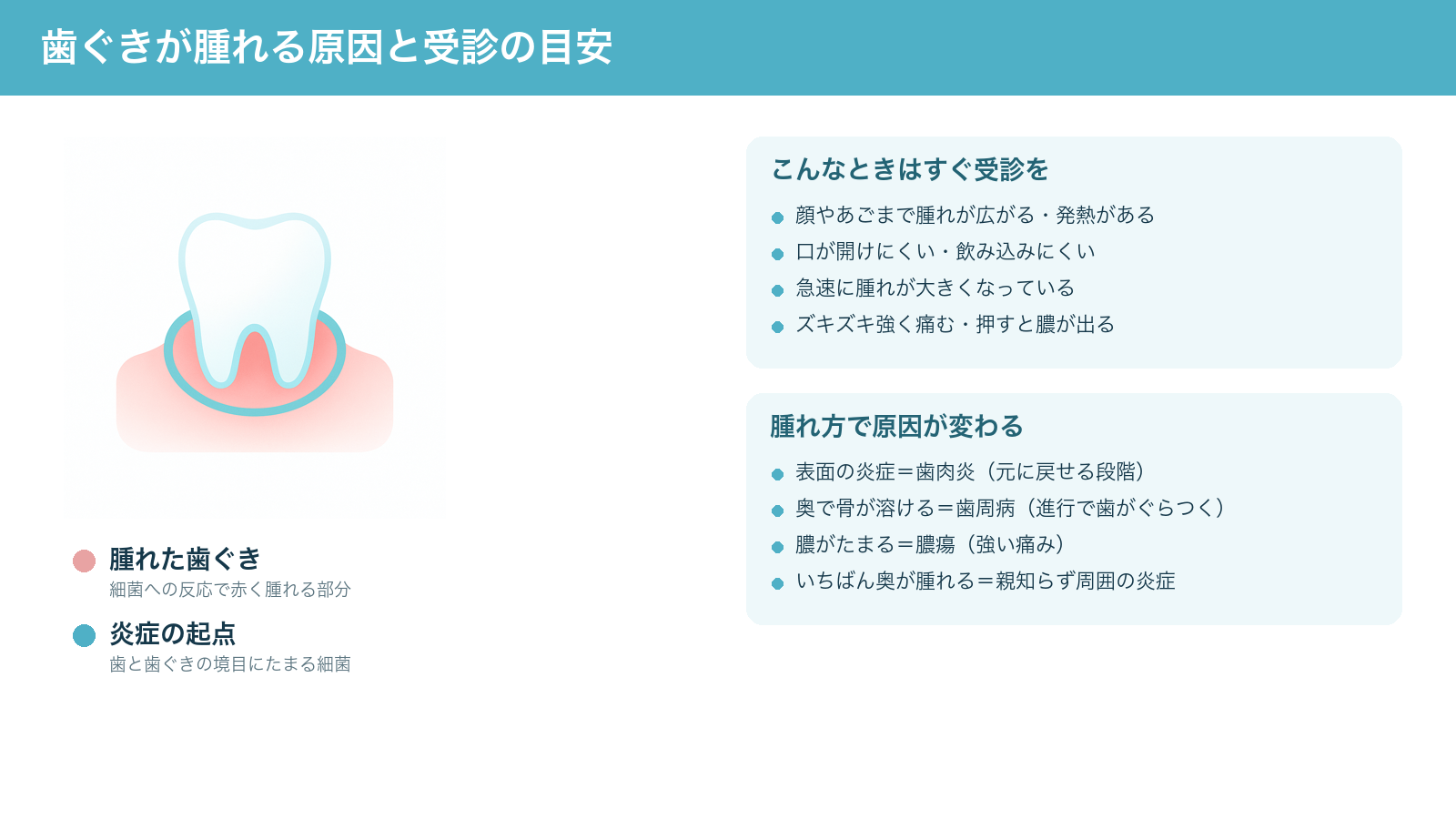 歯ぐきが腫れる原因と受診の目安を示した解説図。歯と歯ぐきの境目の細菌による炎症で歯ぐきが赤く腫れる様子と、すぐ受診すべきサイン、腫れ方による原因の違いをまとめたもの