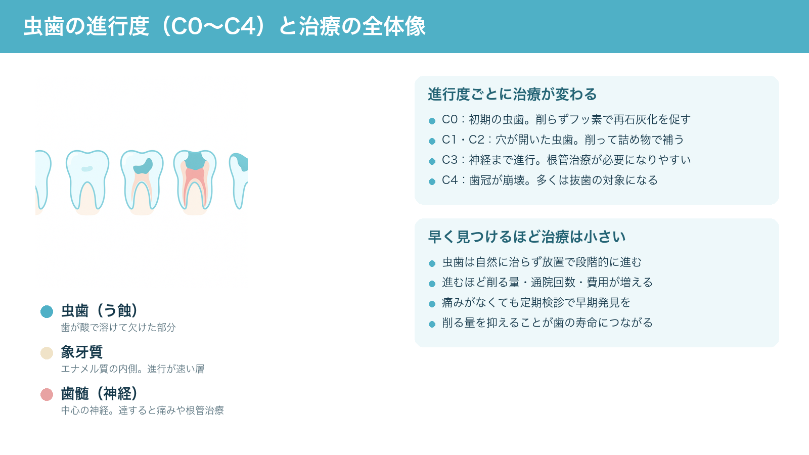 虫歯の進行度C0からC4までの5段階(初期の白い濁りから、エナメル質・象牙質・神経への進行、歯冠の崩壊まで)と、進行度ごとに治療が変わること・早期発見の大切さをまとめた解説図
