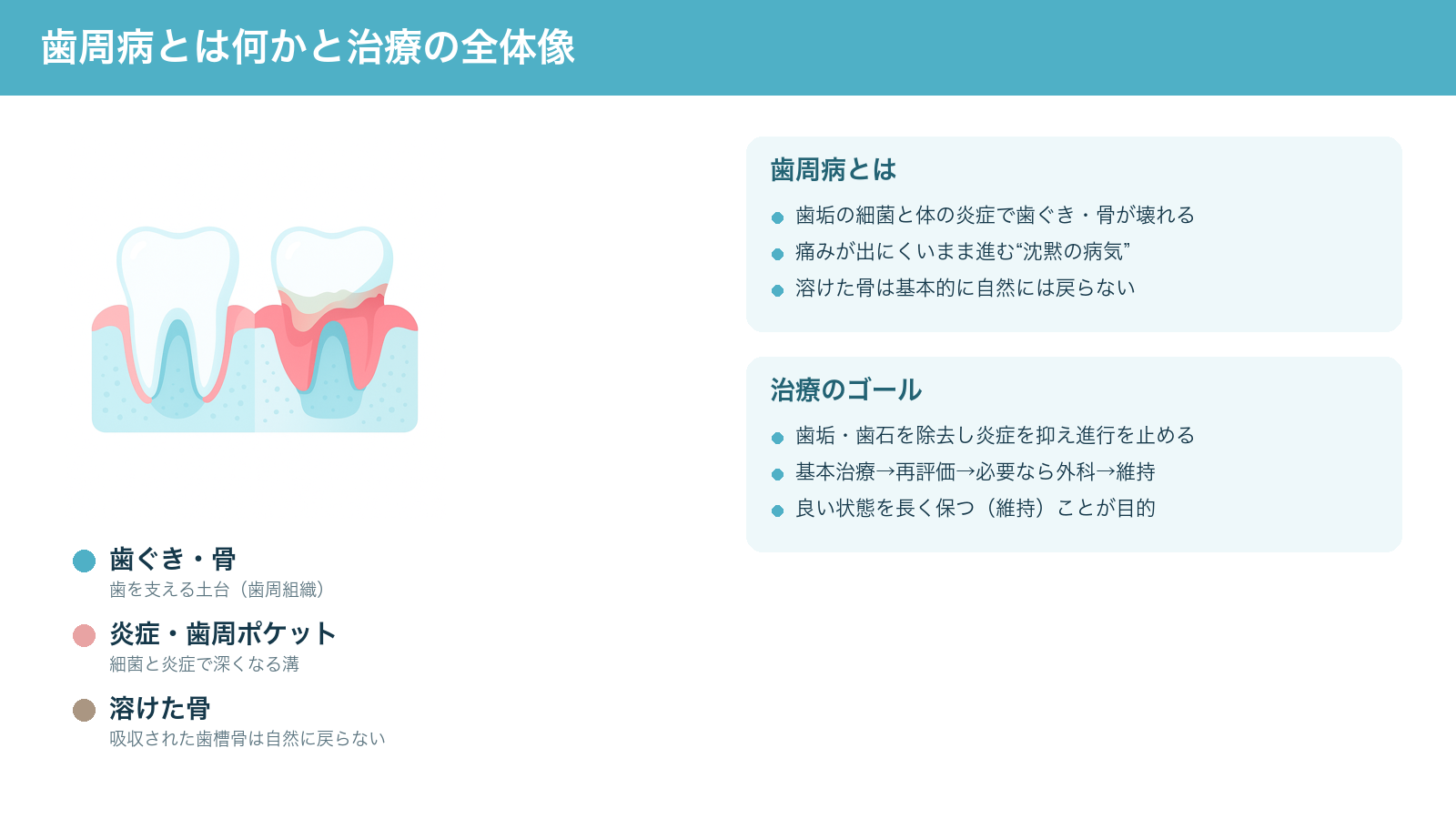 歯周病の仕組みと治療の全体像を示す図。健康な歯ぐきと、炎症で歯周ポケットが深まり骨が溶けた状態を比較し、治療のゴールが進行を止めて維持することだとまとめた解説図