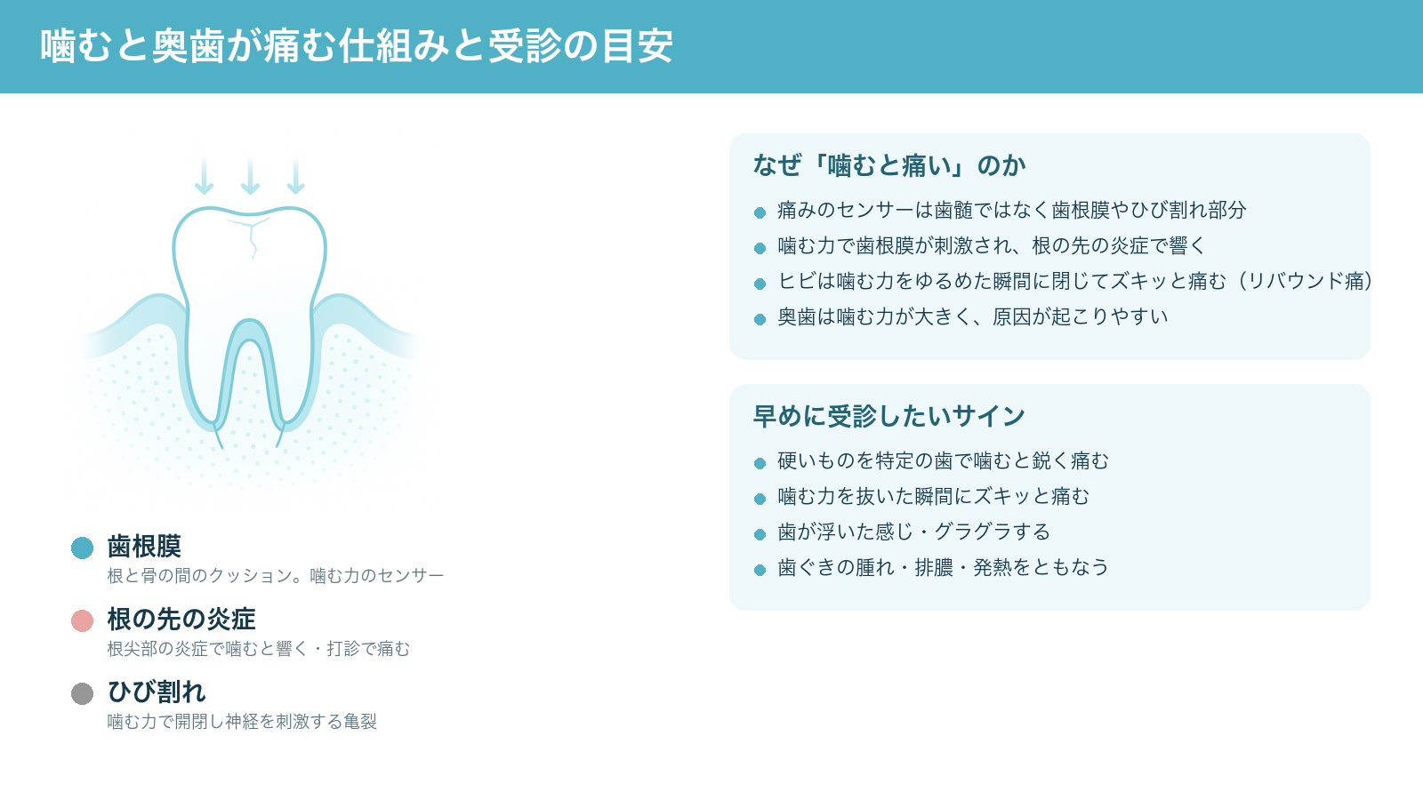 噛むと奥歯が痛む仕組み(歯根膜への力の伝わり方、根の先の炎症、歯のひび割れ)と早めに受診したいサインをまとめた解説図