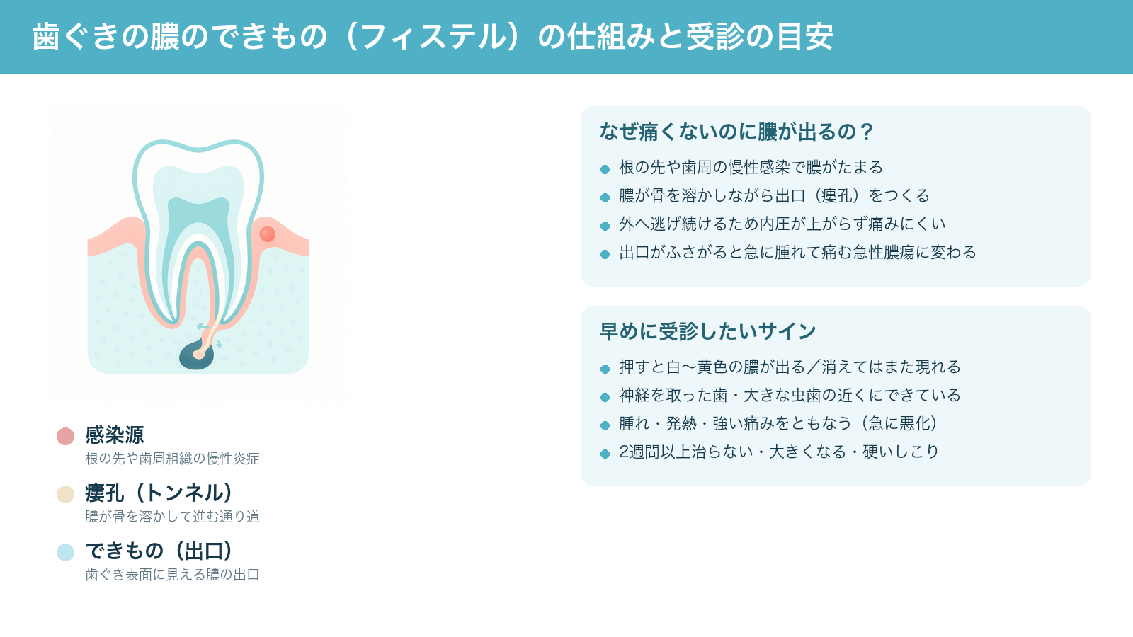 歯ぐきの膿のできもの（フィステル）の仕組みを示す解説図。根の先の慢性感染が膿の出口（瘻孔）をつくり歯ぐき表面にできものとして見えること、痛くなくても受診したいサインをまとめている