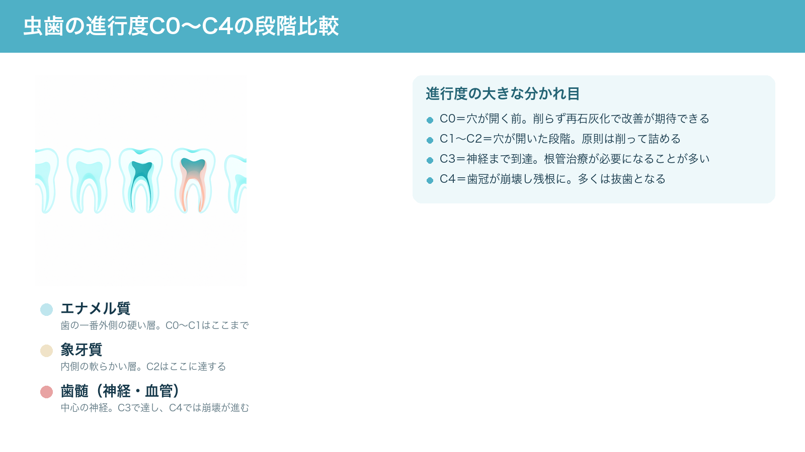 虫歯の進行度C0からC4までの5段階を歯の断面で比較した図。エナメル質の表面下の脱灰から、穴が開き象牙質・神経へ達し、最後は残根になるまでの進み方を示す