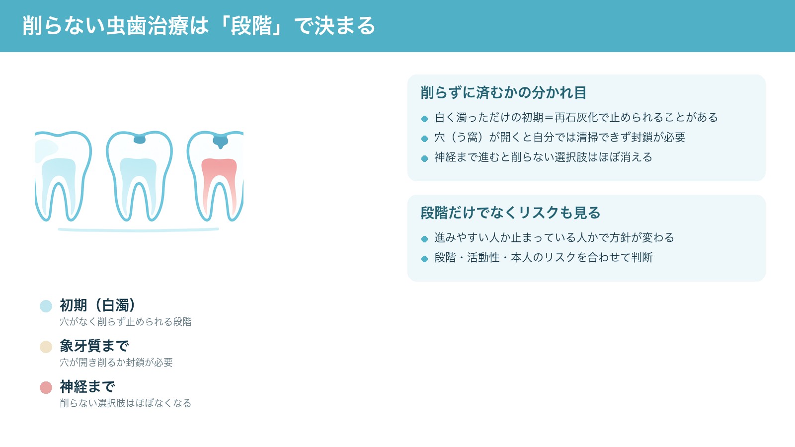 虫歯の進行段階(初期の白濁、象牙質の穴、神経まで)と、削らずに済むかどうかは段階とリスクで決まることをまとめた解説図