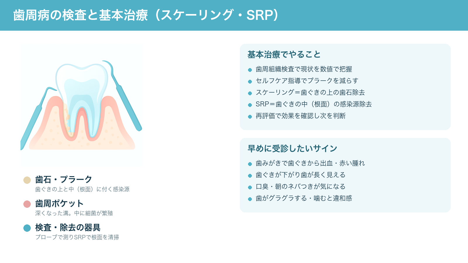歯周病の基本治療の全体像を示す解説図。歯ぐきの上と歯周ポケットの中の根面に付いた歯石・プラークを、検査の器具とSRPで取り除く様子と、早めに受診したいサインをまとめた図