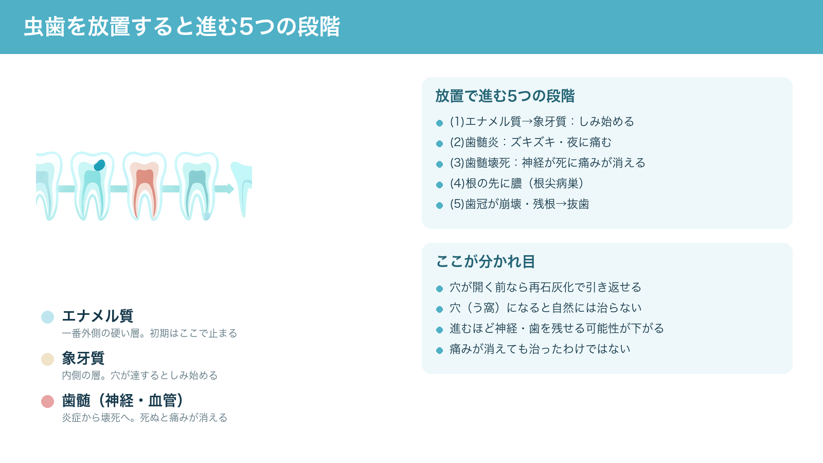 虫歯を放置したときに進む5つの段階(エナメル質から象牙質、歯髄炎、歯髄壊死、根の先の膿、歯冠の崩壊・抜歯)を1本の歯の変化で示した解説図