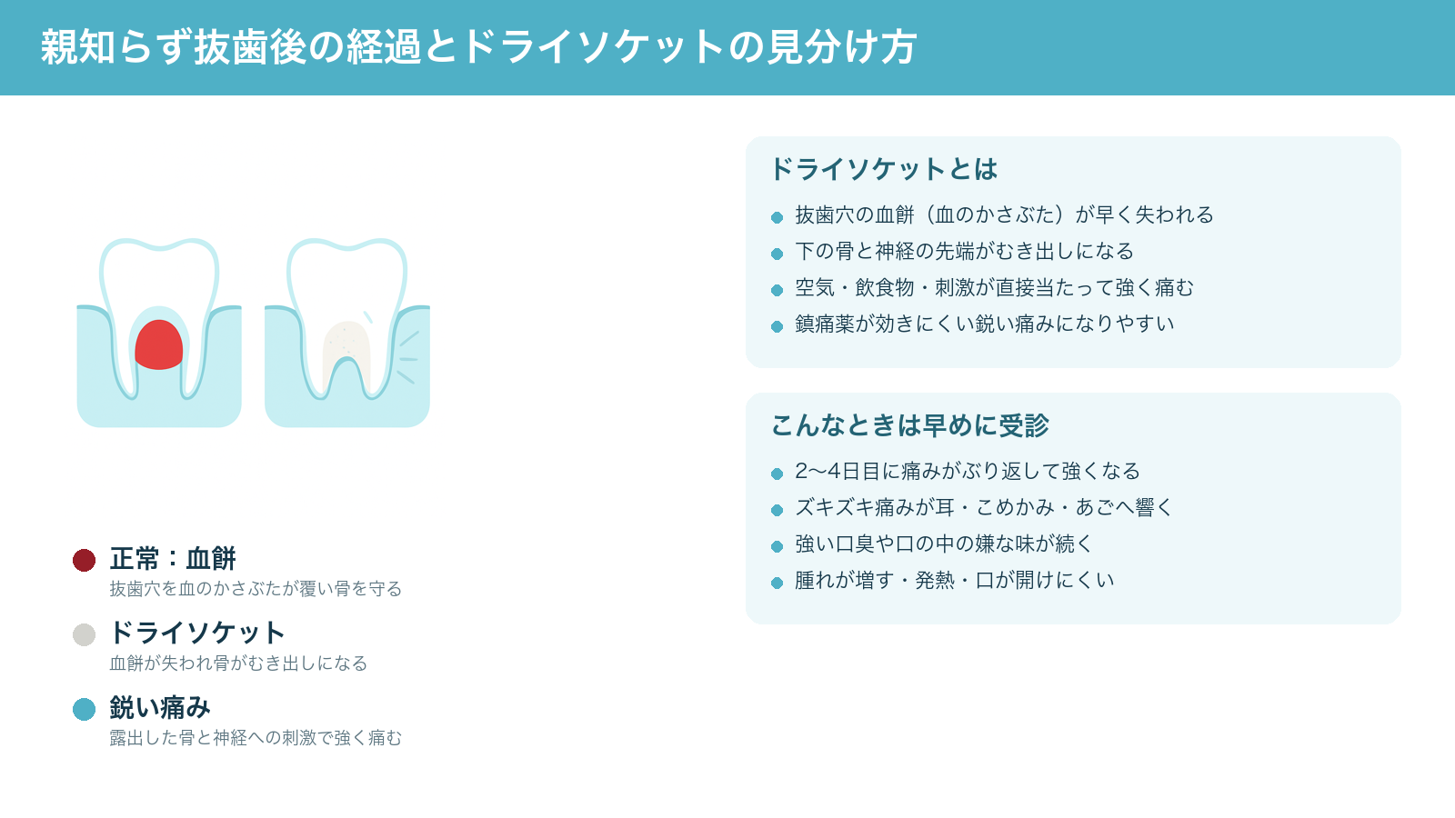 親知らず抜歯後の正常な治癒(血餅が抜歯穴を覆う)とドライソケット(血餅が失われ骨が露出する)の違い、および早めに受診したいサインをまとめた解説図