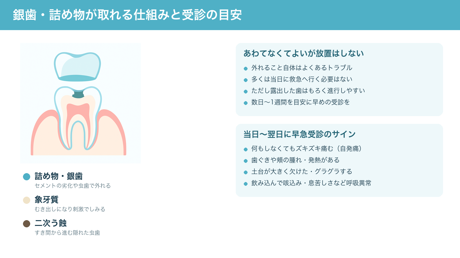 銀歯や詰め物が外れる仕組み(セメントの劣化や二次う蝕、露出した象牙質)と、早めに受診したいサインをまとめた解説図