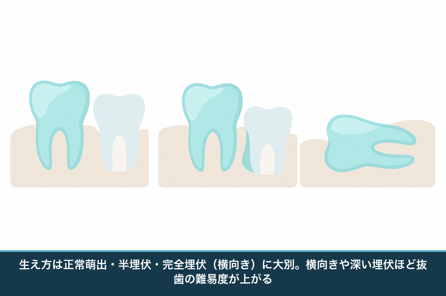 親知らずの生え方の分類図。まっすぐ生える正常萌出、一部だけ出る半埋伏、横向きに埋まる完全埋伏を並べて比較