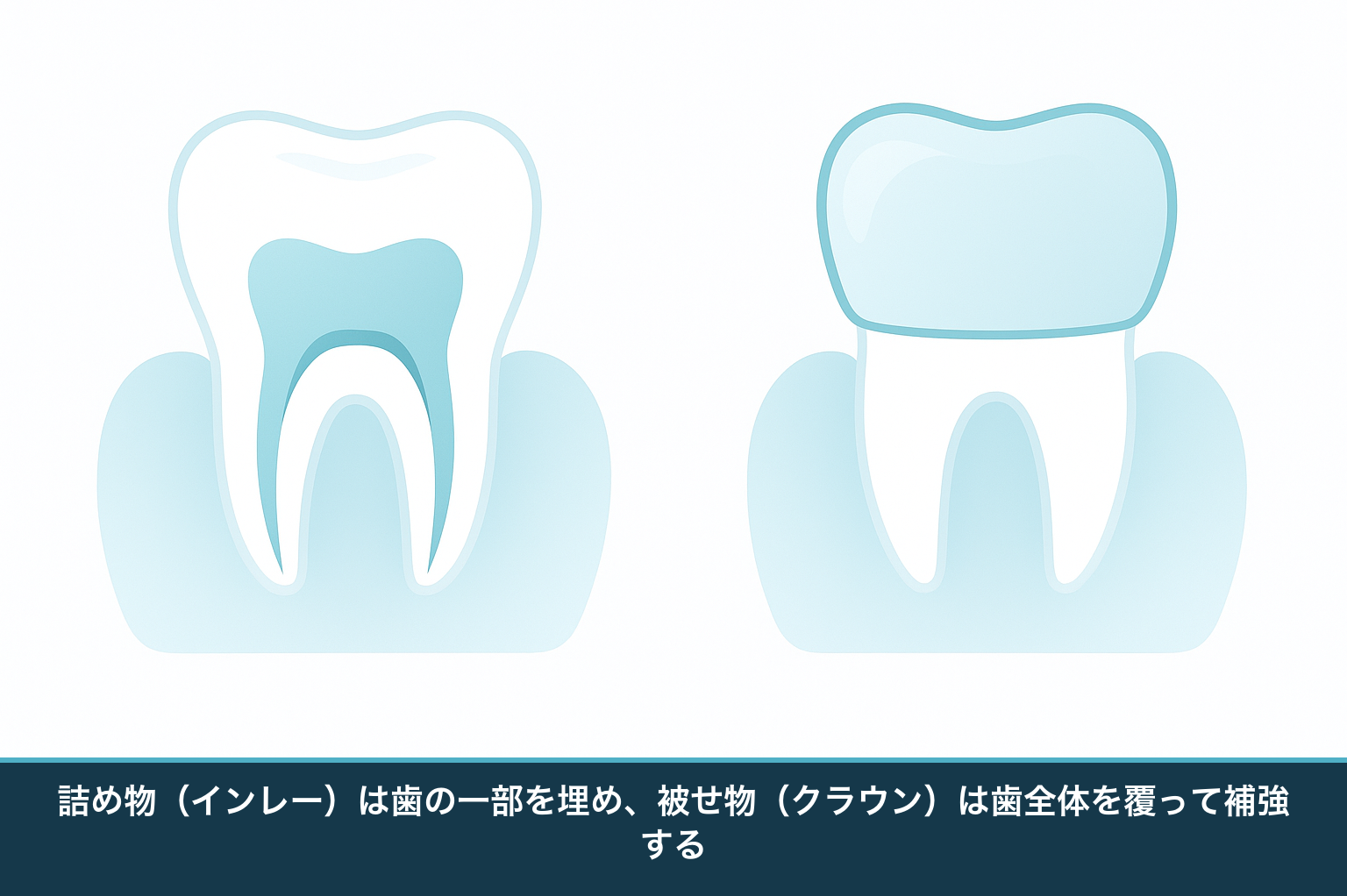詰め物（インレー）と被せ物（クラウン）の違いを示す断面の模式図。インレーは歯の一部の穴を埋め、クラウンは歯全体を覆う