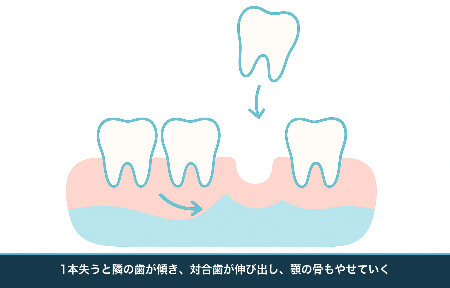 歯を1本失ったまま放置したときの変化を示す模式図。両隣の歯の傾斜・移動、対合歯の挺出、顎の骨の吸収