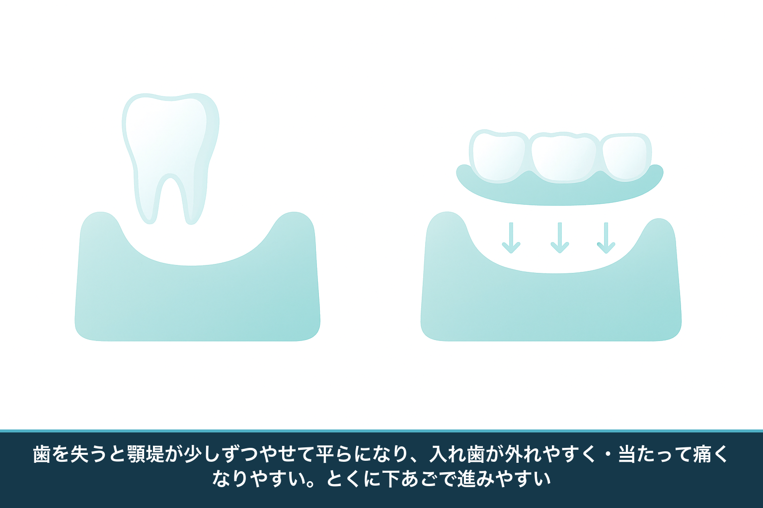 歯を失った後にあごの骨（顎堤）が時間とともにやせて平らになり、入れ歯の吸着が弱まる仕組みを示した模式図