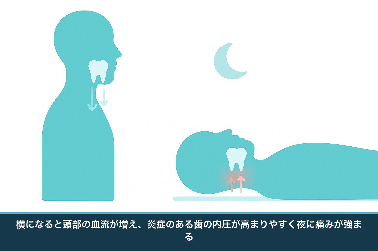 立っているときと横になったときの比較図。横になると頭部や顔まわりの血流が増え、炎症のある歯の歯髄内圧が高まって夜に痛みが強まりやすいことを示す模式図