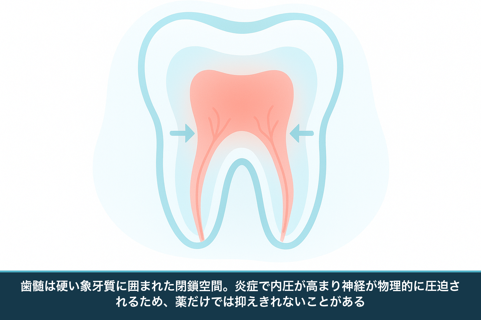 歯の断面の模式図。中心の歯髄（神経・血管）が硬い象牙質に囲まれ、炎症で内圧が高まり神経が圧迫される様子