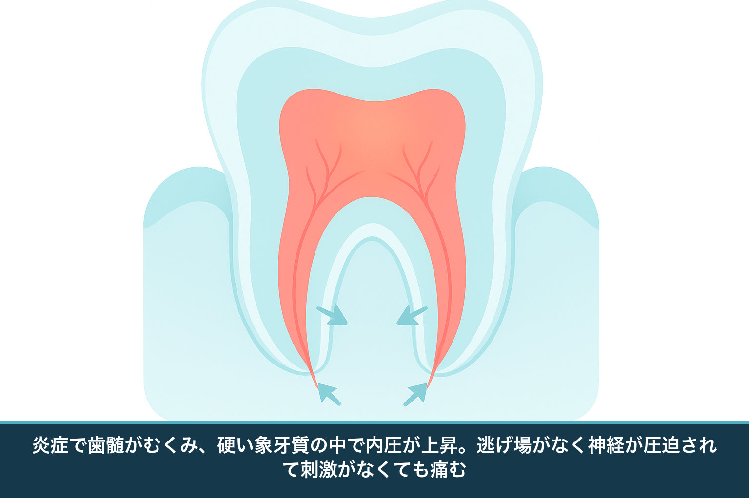 歯の断面の模式図。中心の歯髄（神経・血管）が硬い象牙質に囲まれ、炎症でむくんで内圧が高まり、刺激がなくても神経が圧迫されて痛む様子