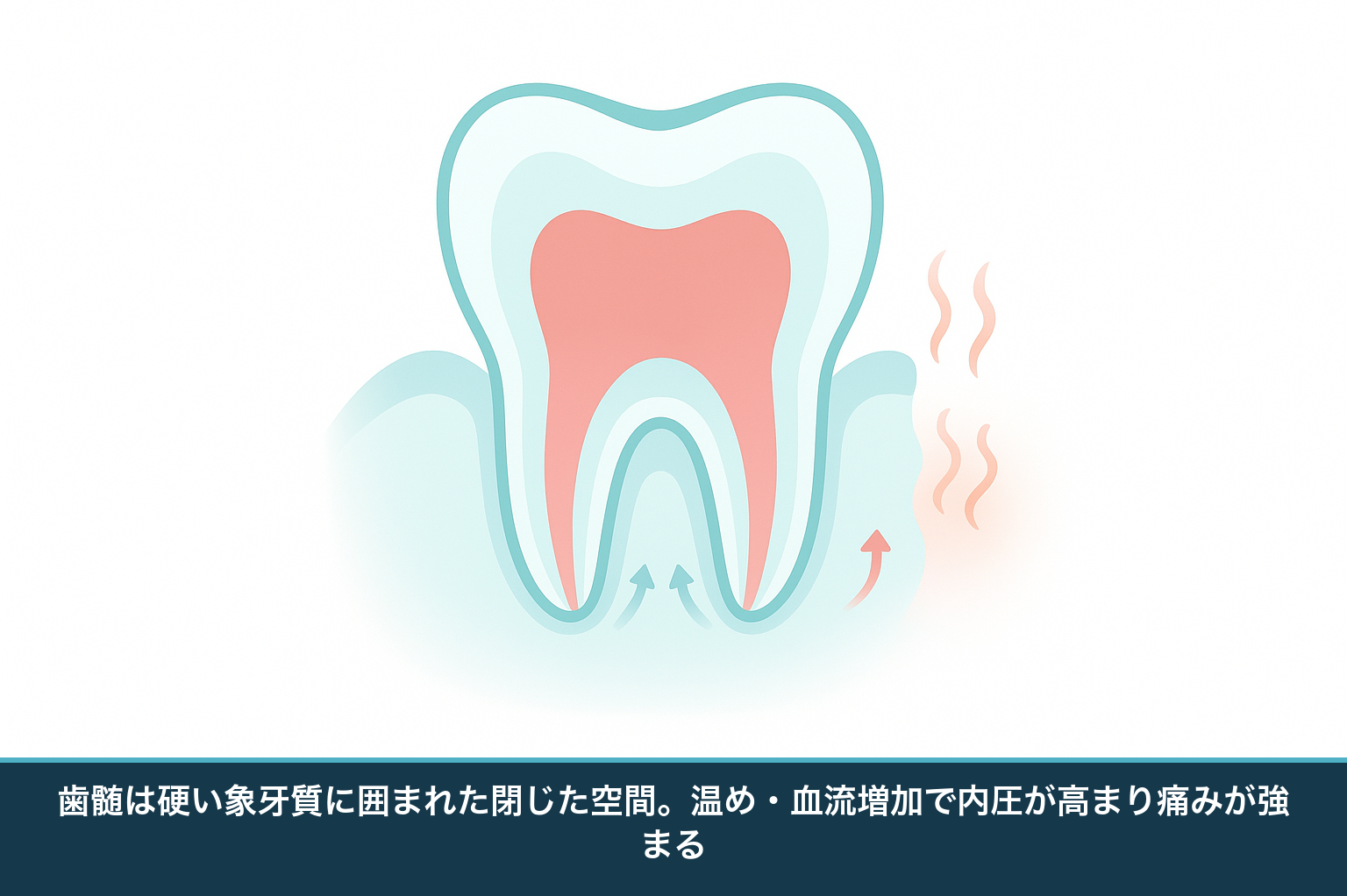 歯の断面の模式図。硬い象牙質に囲まれた歯髄が炎症でむくみ、温めや血流増加で内圧が高まって痛みが強くなる仕組み