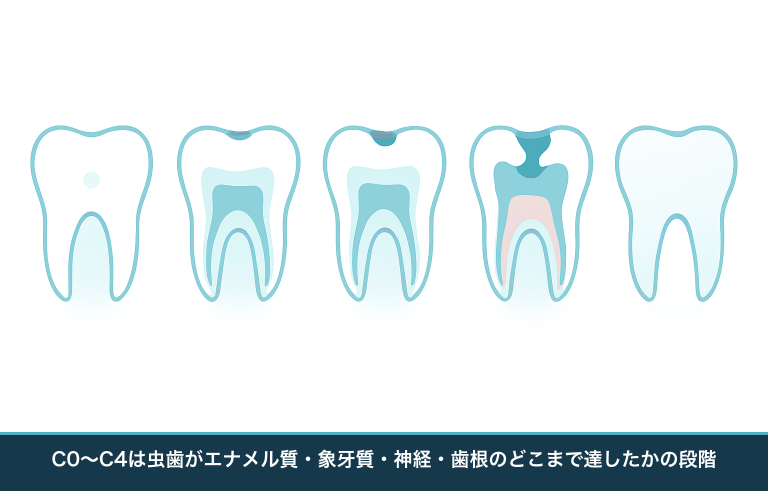 C0からC4まで虫歯が歯のどの層まで達しているかを並べて比較した模式図