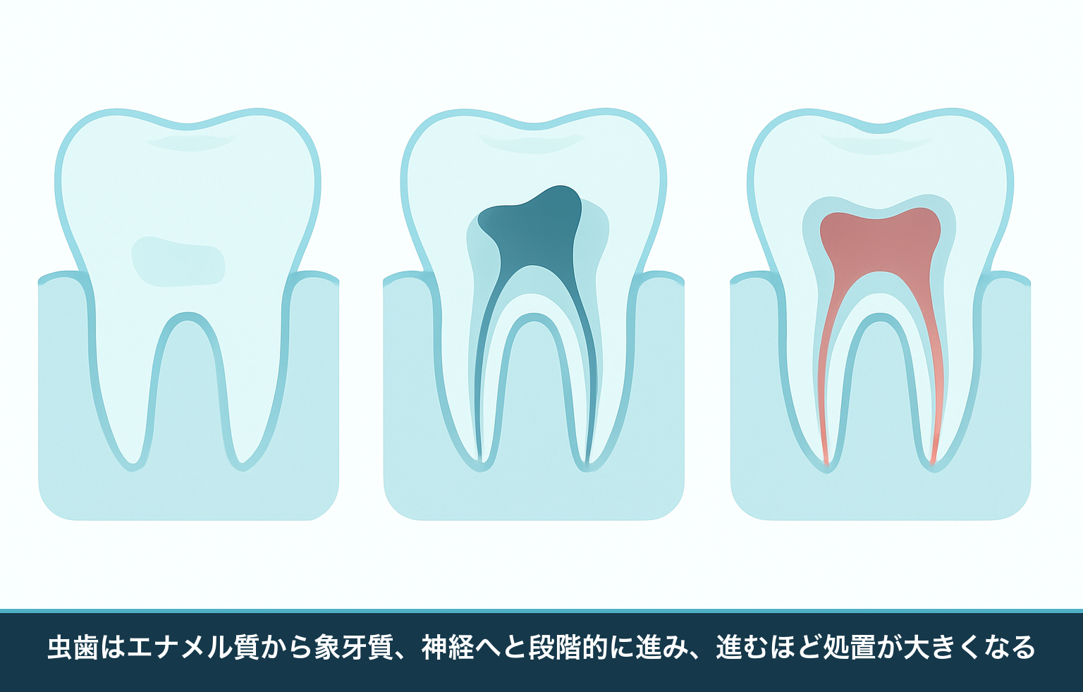 虫歯がエナメル質から象牙質、歯の神経(歯髄)へと段階的に進行していく断面の模式図