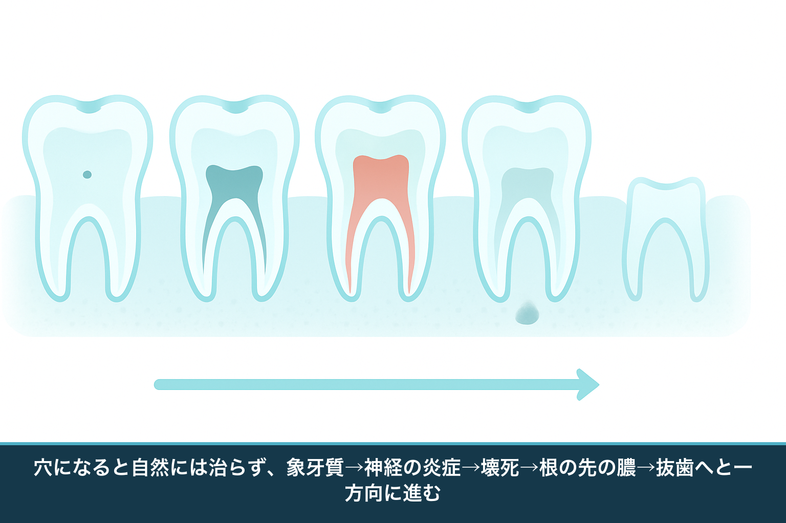 虫歯の進行を1本の歯の断面の連続で示した模式図。エナメル質の小さな虫歯から象牙質、歯髄の炎症、神経の壊死、根の先の膿、歯冠の崩壊・残根へと段階的に進む