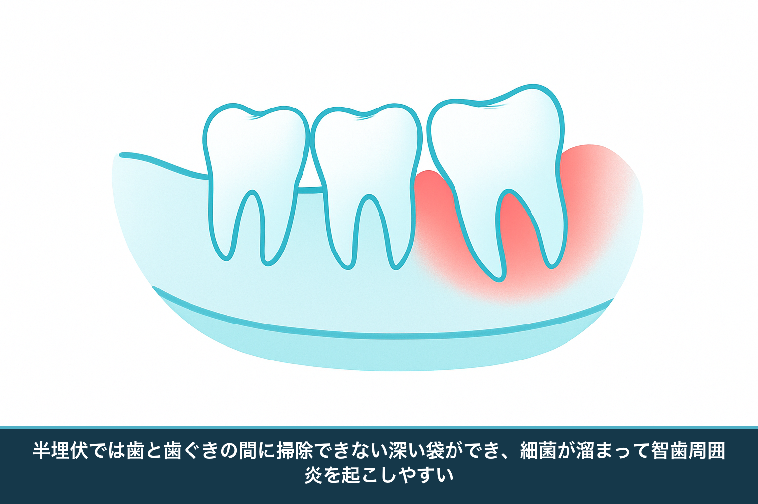 半埋伏の親知らずの模式図。歯冠の一部だけが歯ぐきから出て深いポケットができ、食べかすや細菌が溜まって周囲の歯ぐきが炎症を起こす様子