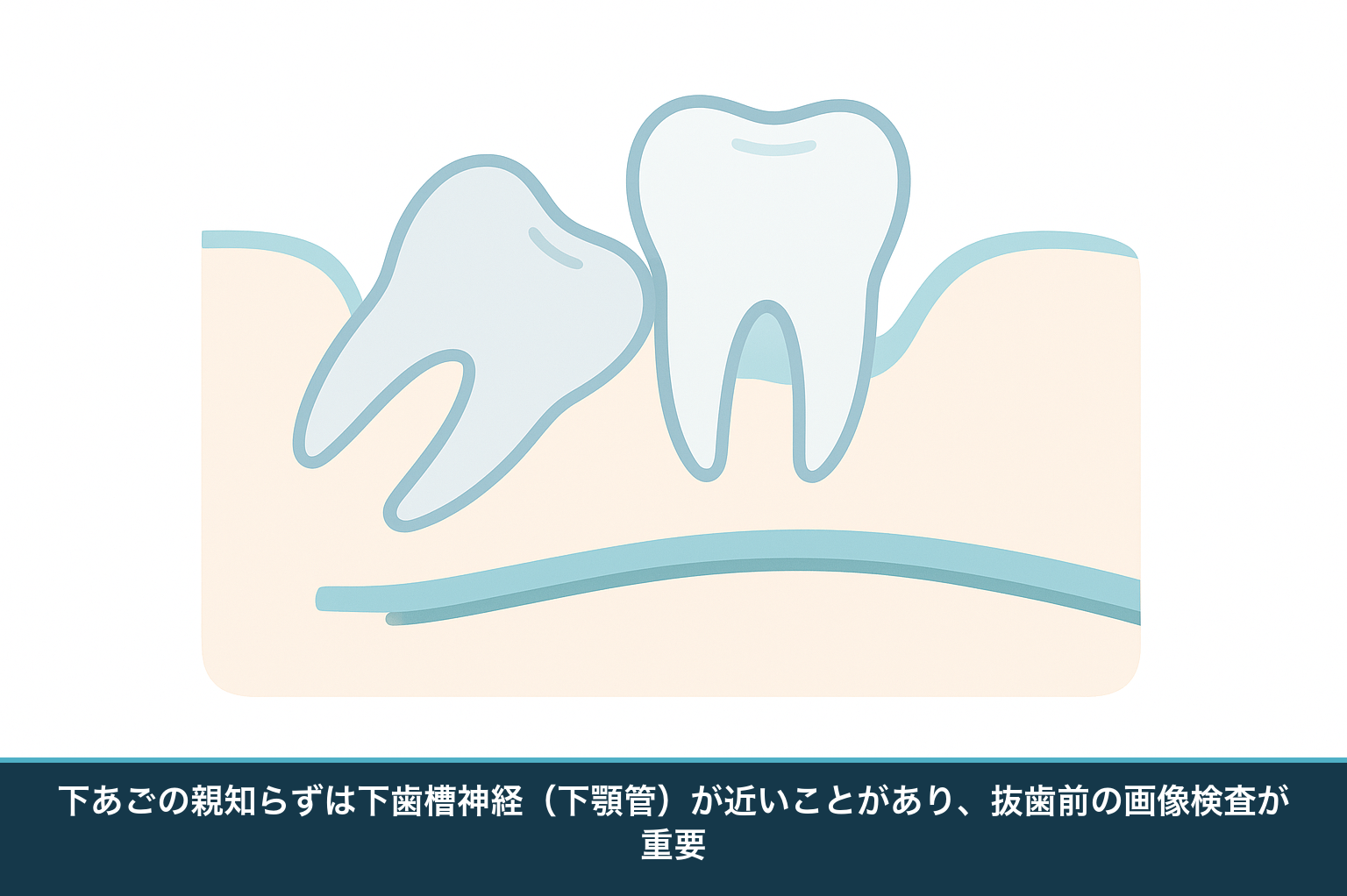 下あごの親知らずの根が下歯槽神経の通る下顎管に近づいている様子を示した断面図