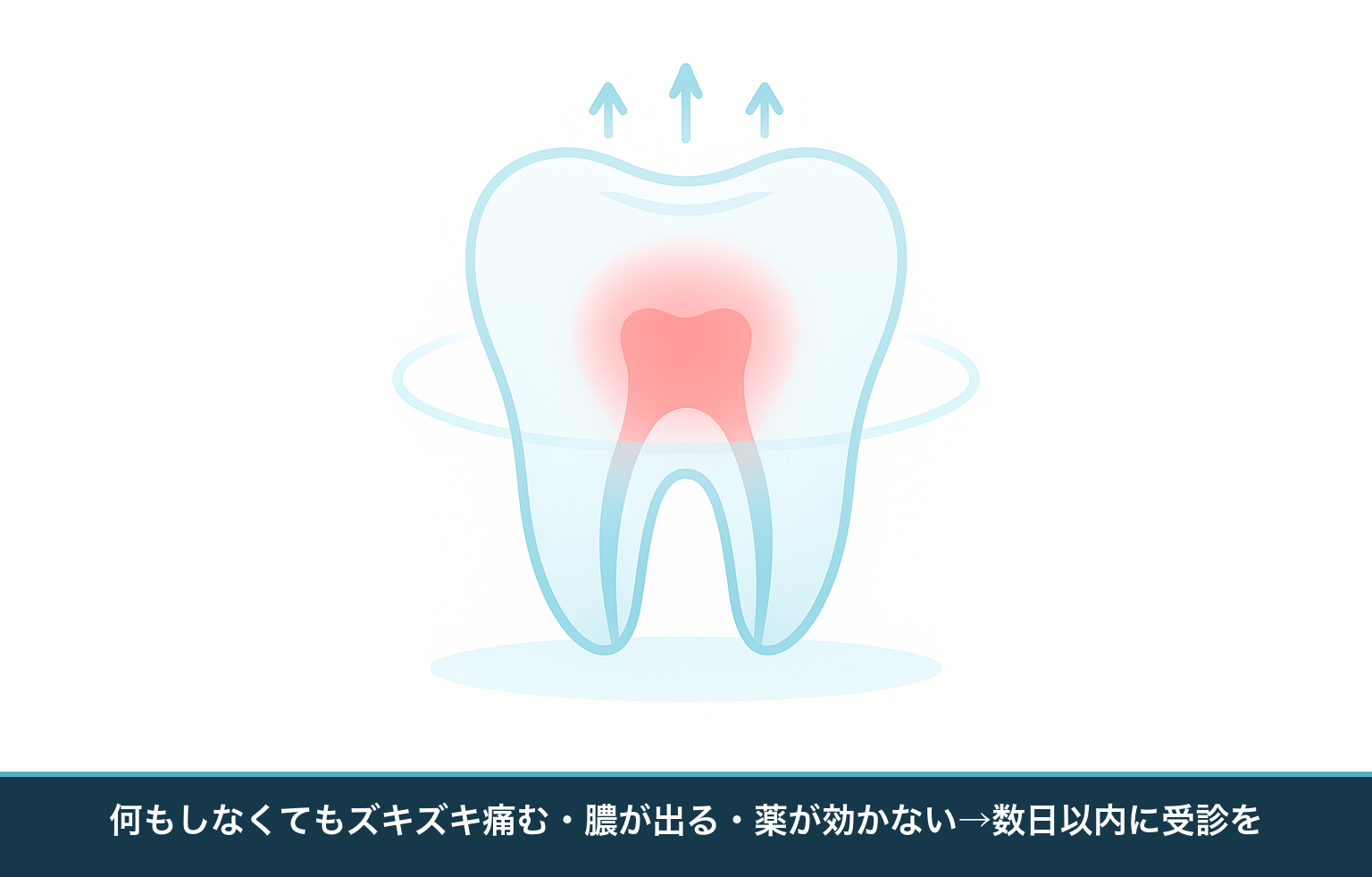 歯の神経の炎症が進み内圧が高まってズキズキ痛む様子と、数日以内に受診したいサインを示す断面の模式図