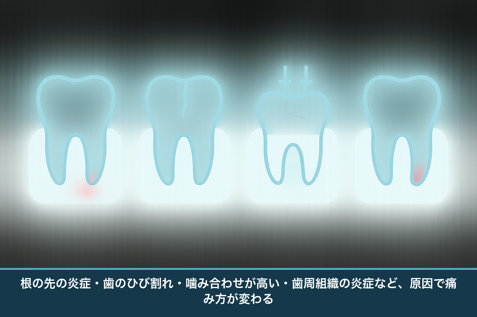 噛むと奥歯が痛む主な原因(根尖性歯周炎・歯のひび割れ・噛み合わせが高い・歯周膿瘍)を並べて見分ける模式図