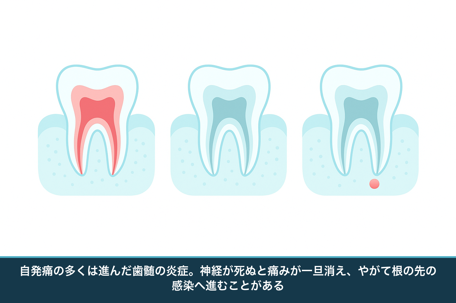 自発痛で考えられる原因の進行を示す図。歯髄の炎症（不可逆性歯髄炎）から神経が死んだ状態（歯髄壊死）、さらに根の先の炎症へと進む流れ