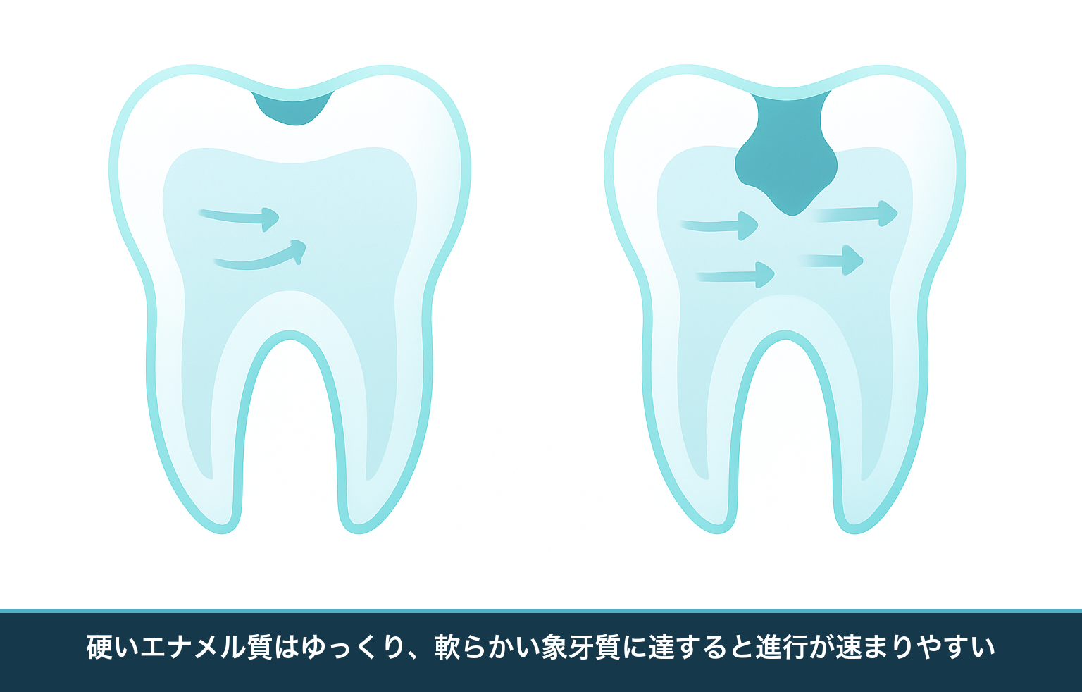 エナメル質の段階はゆっくり進み、象牙質に達すると横へ広がりながら進行が速まる様子を比較した図