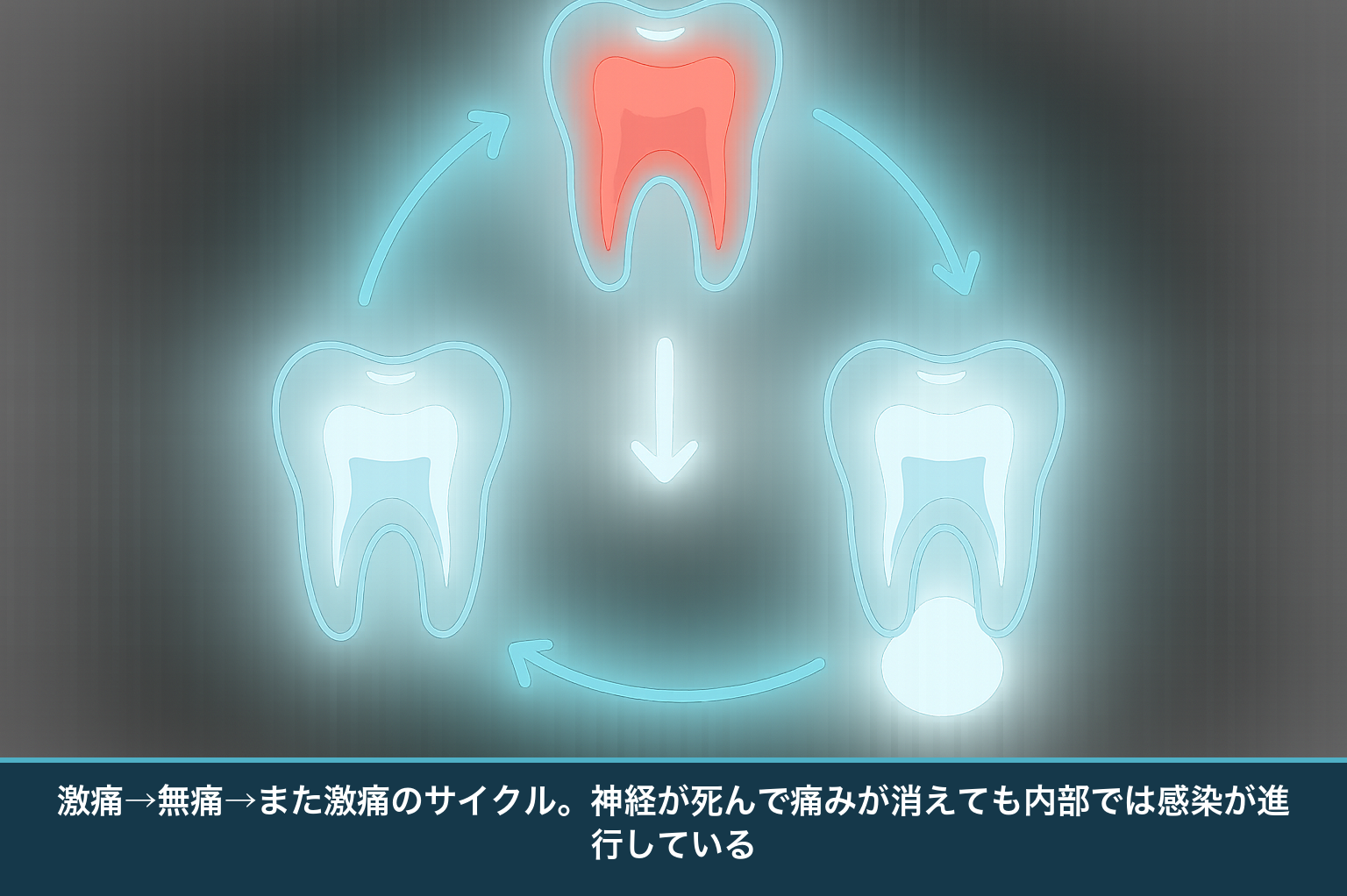 歯の痛みのサイクルを示す模式図。神経の炎症による激痛、神経が死んで無痛になる時期、根の先に膿がたまり再び痛む時期を循環で表し、その間に病気が進行することを示す