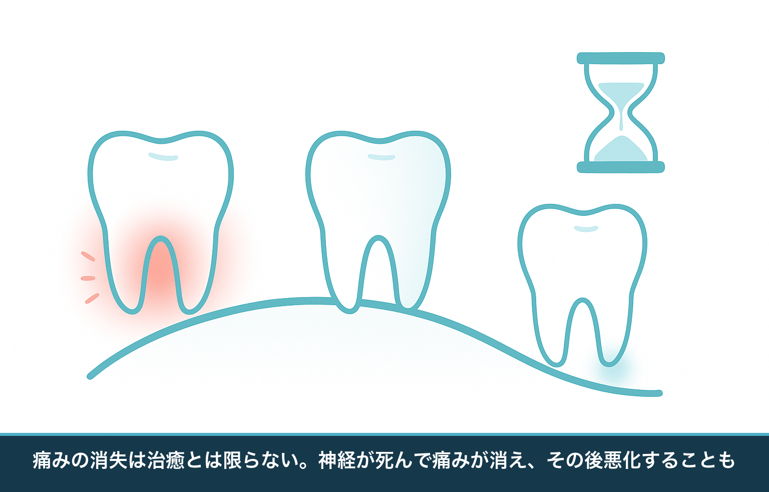 痛みが引いても治ったとは限らないことを示す図。歯の神経が死んで痛みが消えた後、根の先で炎症が進み腫れや膿に至る経過