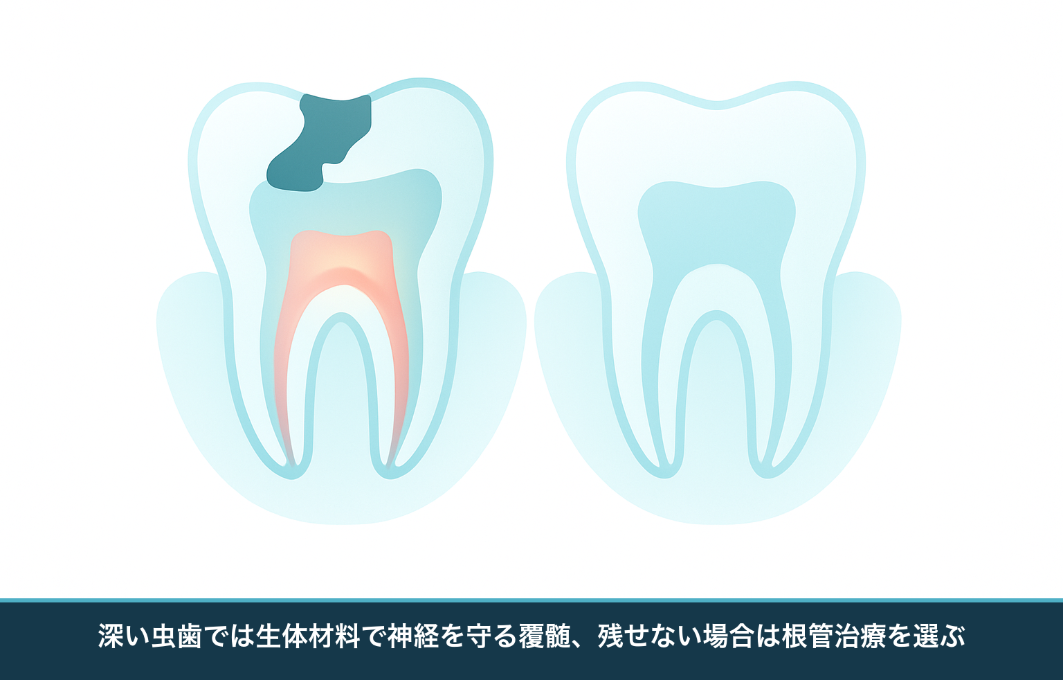 深い虫歯に対して神経を保護する覆髄と、神経を取り除く根管治療の違いを示す模式図