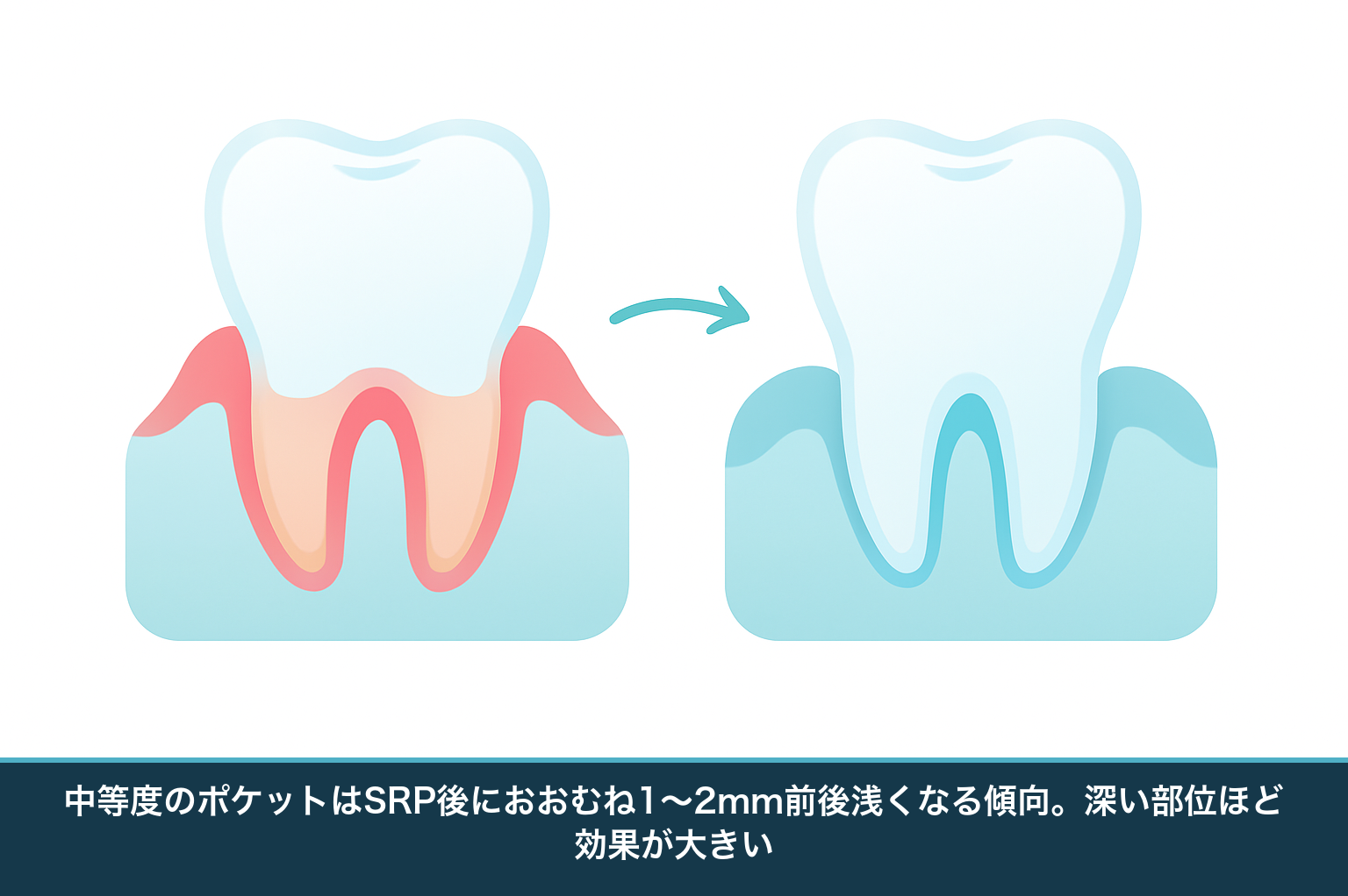 SRPによる治療効果を示す図。炎症で深かった歯周ポケットが、SRP後に歯ぐきが引き締まって浅くなる様子を治療前後で比較