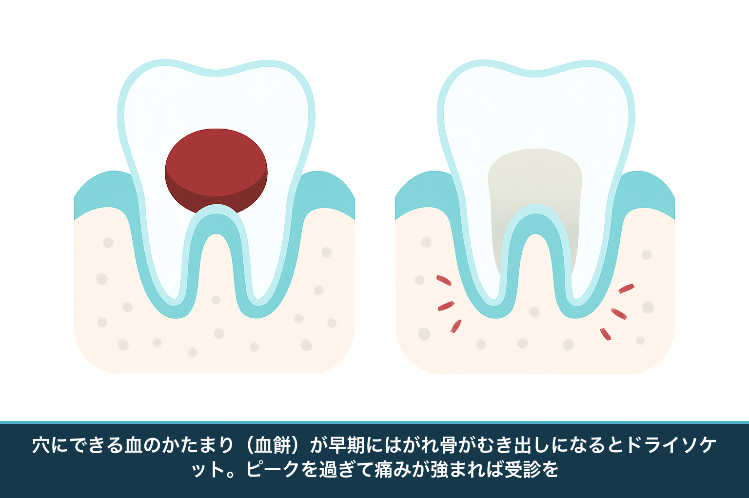 ドライソケットの仕組みを示す図。健康な抜歯窩は血餅で覆われ守られるが、血餅がはがれて骨がむき出しになると強く痛む状態を左右で比較